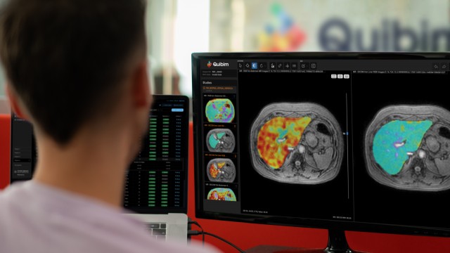 Quibim lanza una IA para el diagnóstico por resonancia magnética de enfermedades hepáticas