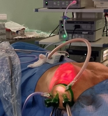 El Hospital del Vinalopó implanta la mastectomía endoscópica, una técnica 