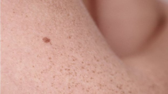 Los lunares en los brazos ayudan a predecir el riesgo de cáncer de piel