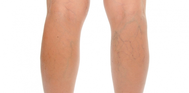 Recomendaciones para evitar que el verano empeore los síntomas en las personas con varices