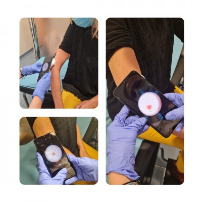 HCB Calpe pone en marcha el servicio rápido de diagnóstico dermatológico por imagen