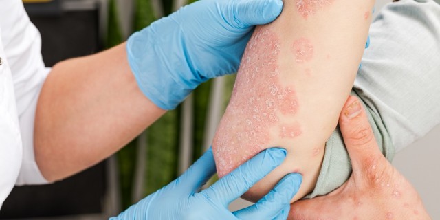 Los avances terapéuticos permiten una remisión completa de la psoriasis en el 50% de los casos