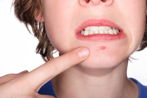 El 24% de las consultas dermatológicas son por acné