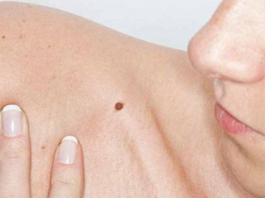 El cambio de color en lunares puede ser una señal de cáncer de piel, evitable con el uso de protección solar