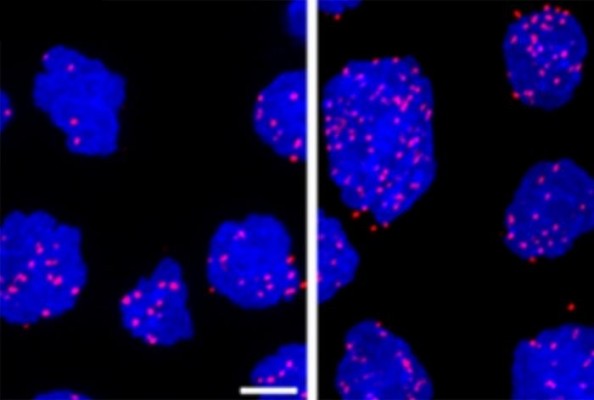 Un estudio muestra que una terapia combinada es eficaz para tratar el linfoma B agresivo

