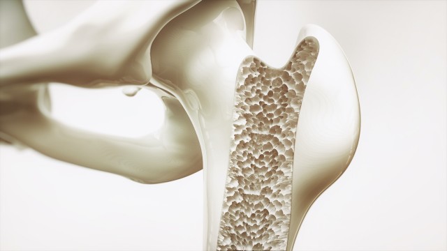 La mortalidad de las fracturas osteoporóticas por fragilidad supera el 15% anual y puede ser del 20%