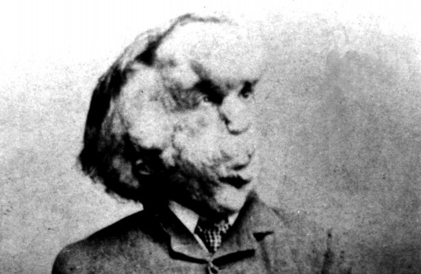 Joseph Merrick, el somni de l’Home Elefant

