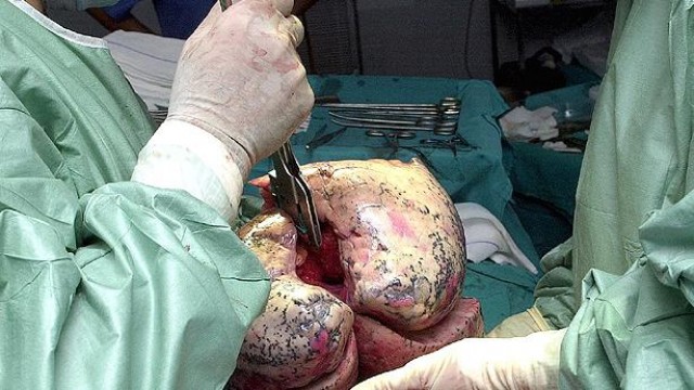 Hay escasez de donantes para cubrir la demanda de trasplantes pulmonares