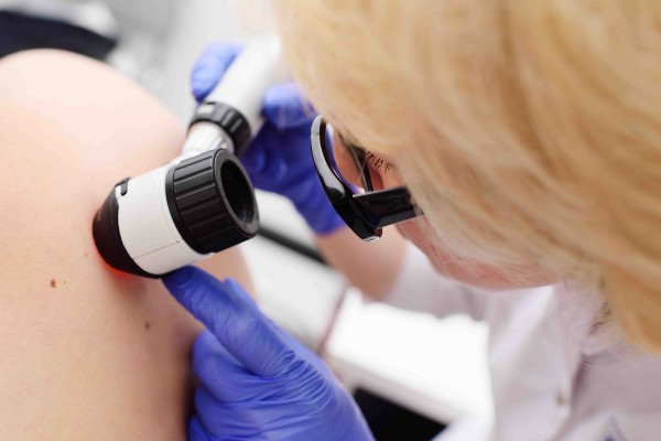 Las quemaduras en la infancia, principales factores del melanoma y otros cánceres cutáneos