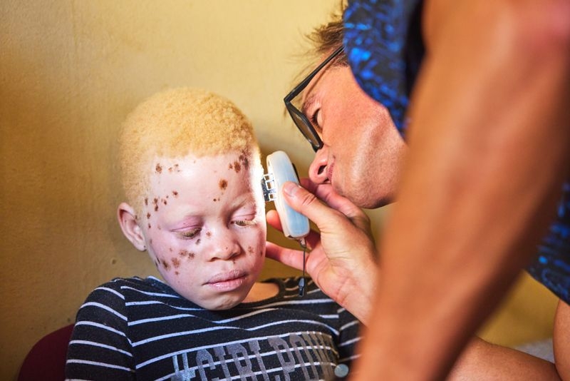 ISDIN ayuda a las personas con albinismo de Mozambique a luchar contra el cáncer de piel
