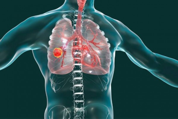Un 38% de las personas diagnosticadas con cáncer en 2022 tenían entre 40 y 65 años

