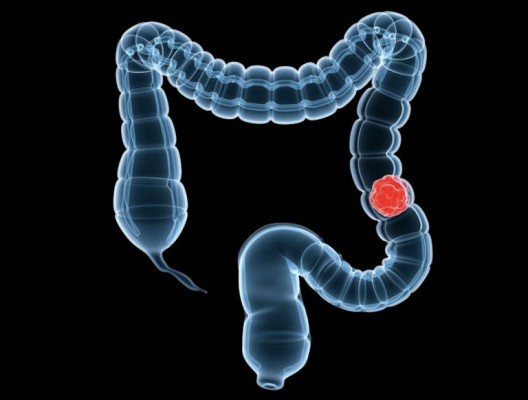 Día Mundial del Cáncer de Colon: nueve de cada diez casos se curan si se detectan en estadios tempranos