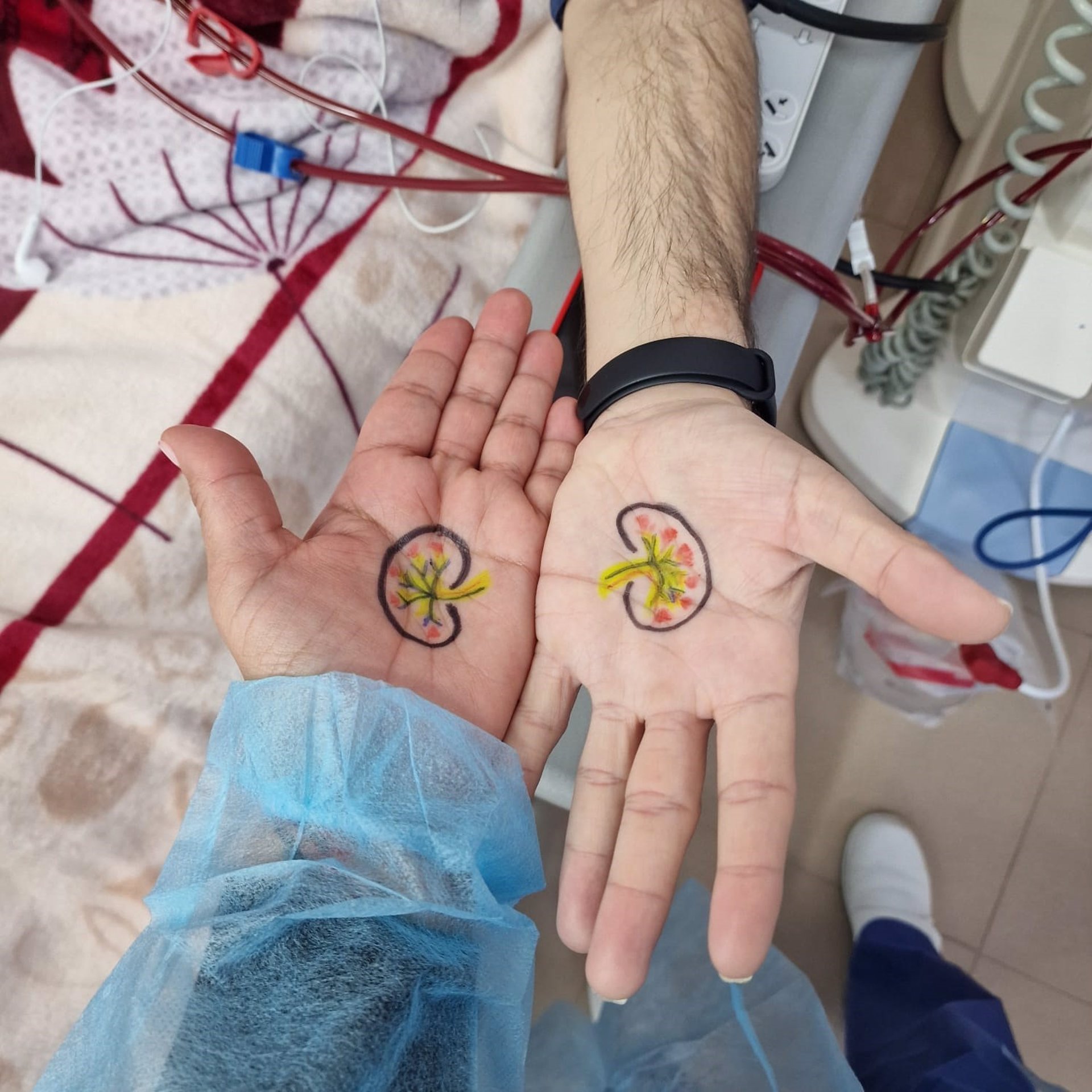 Más de la mitad de los pacientes con enfermedad renal crónica en diálisis tiene desnutrición
