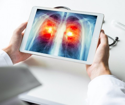 Un estudio demuestra que es necesario extirpar menos tejido pulmonar en el cáncer en estadio inicial
