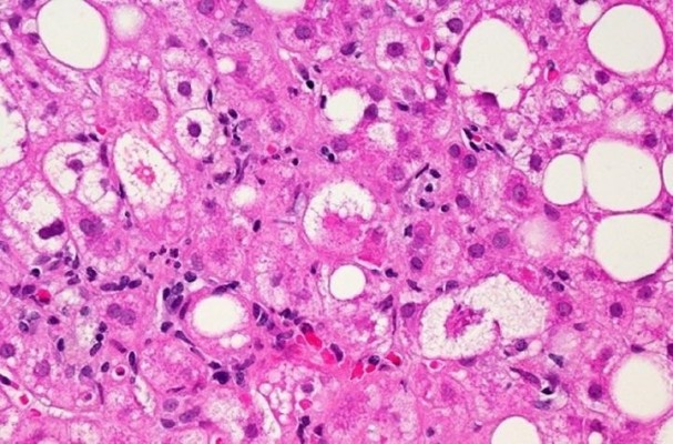 Descubren nuevas dianas terapéuticas para tratar la enfermedad del hígado graso no alcohólico
