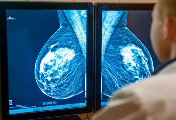Cáncer de mama: los tratamientos son cada vez menos agresivos y más eficientes
