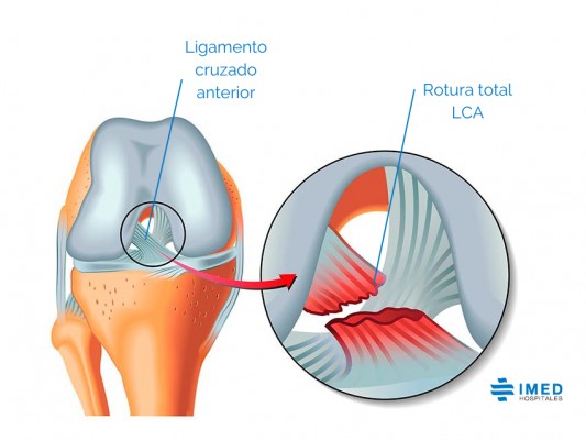 La rotura de ligamento cruzado anterior: mujeres, más propensas que los hombres