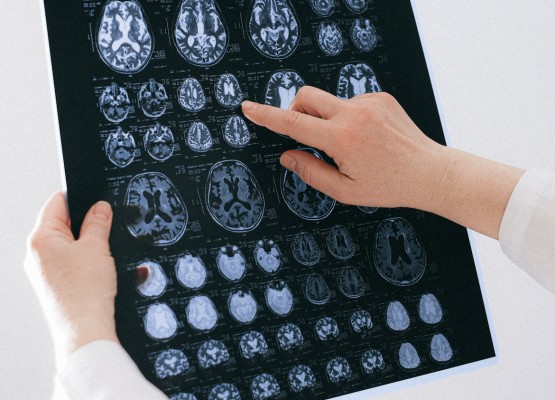La mala salud del corazón predice el envejecimiento prematuro del cerebro

