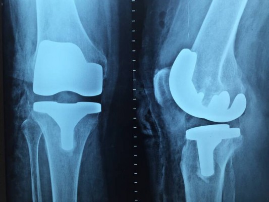 Una investigación revela problemas de curación de fracturas en personas con síndrome de Down
