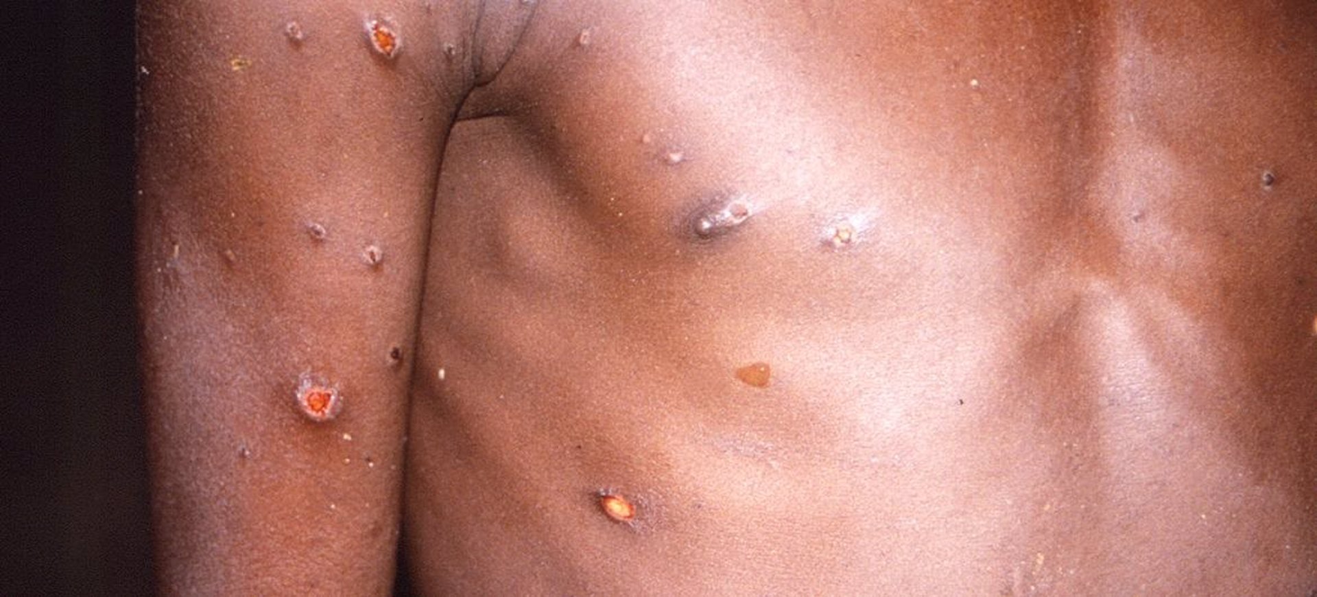 La viruela del mono. Foto: CDC - 