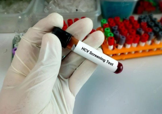 Expertos destacan las estrategias de cribado oportunista para facilitar el objetivo de eliminación de la hepatitis C en España
