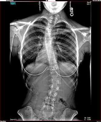 Un kit permite a los afectados de escoliosis reducir las pruebas radiológicas