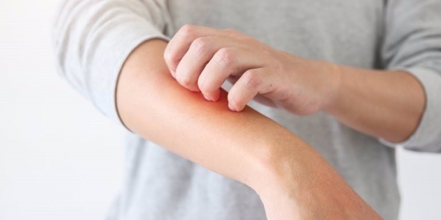 Dermatólogos aseguran que las patologías de la piel pueden mejorar con el sol y el mar