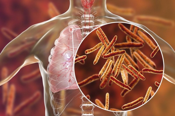 La desnutrición y las infecciones intestinales perjudican los tratamientos contra la tuberculosis en los niños

