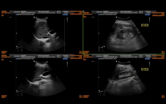 ¿En qué consiste la litiasis renal?