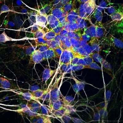 Investigadores descubren el mecanismo biológico que causa la destrucción de los nervios en la ELA
