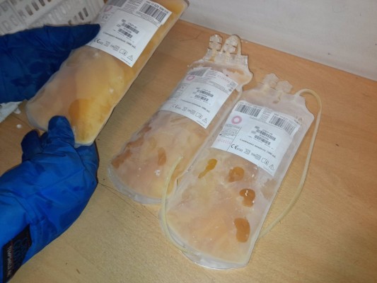  El plasma de pacientes recuperados de covid podría ayudar a evitar la hospitalización, según un estudio