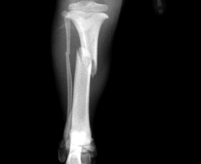 Vidrio para reparar las fracturas óseas