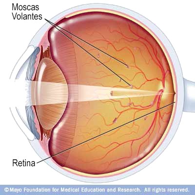Las 'moscas volantes' en el ojo pueden causar problemas psicológicos 