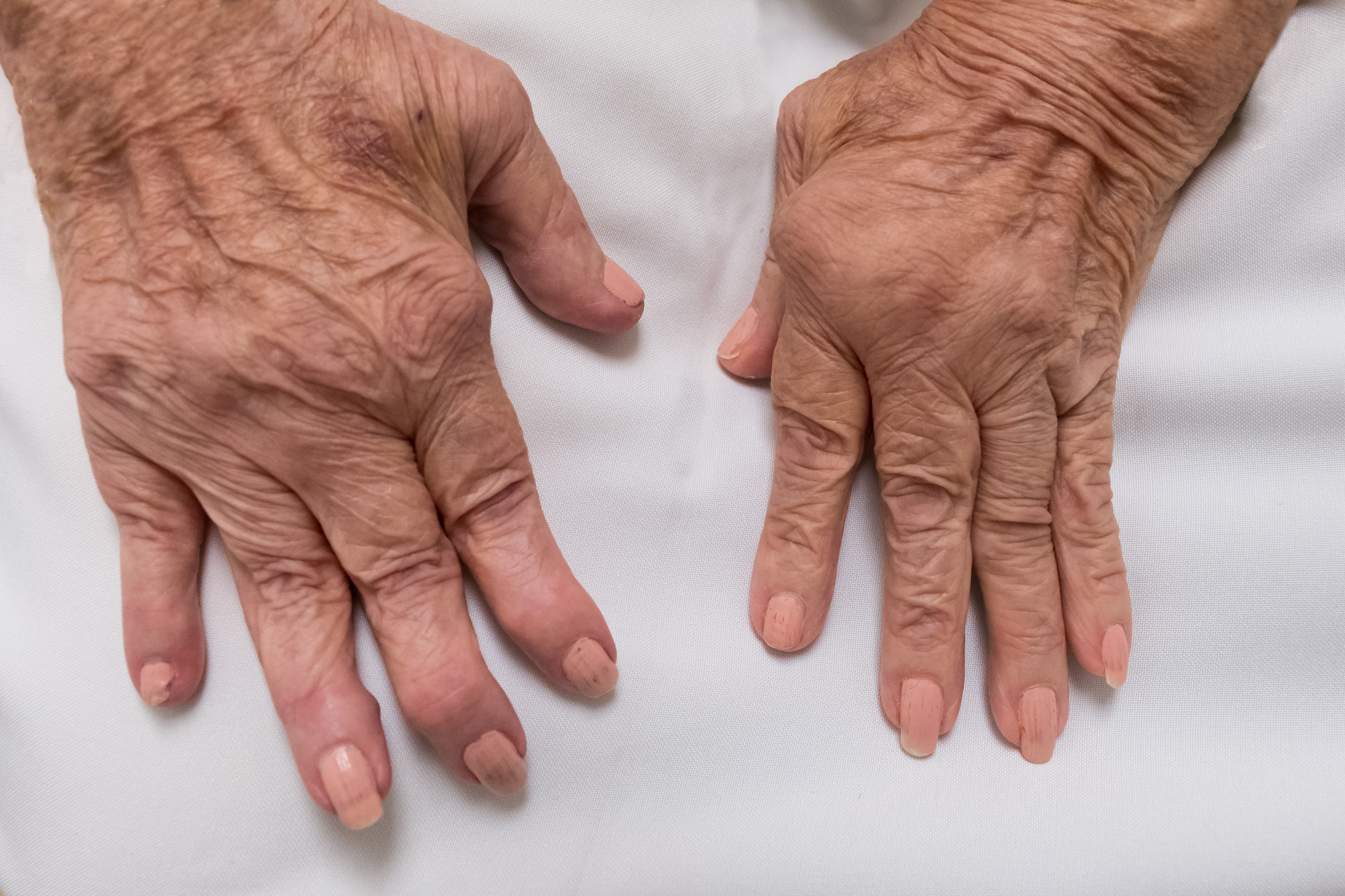 El tabaco duplica el riesgo de padecer artritis reumatoide, la enfermedad inflamatoria articular más frecuente