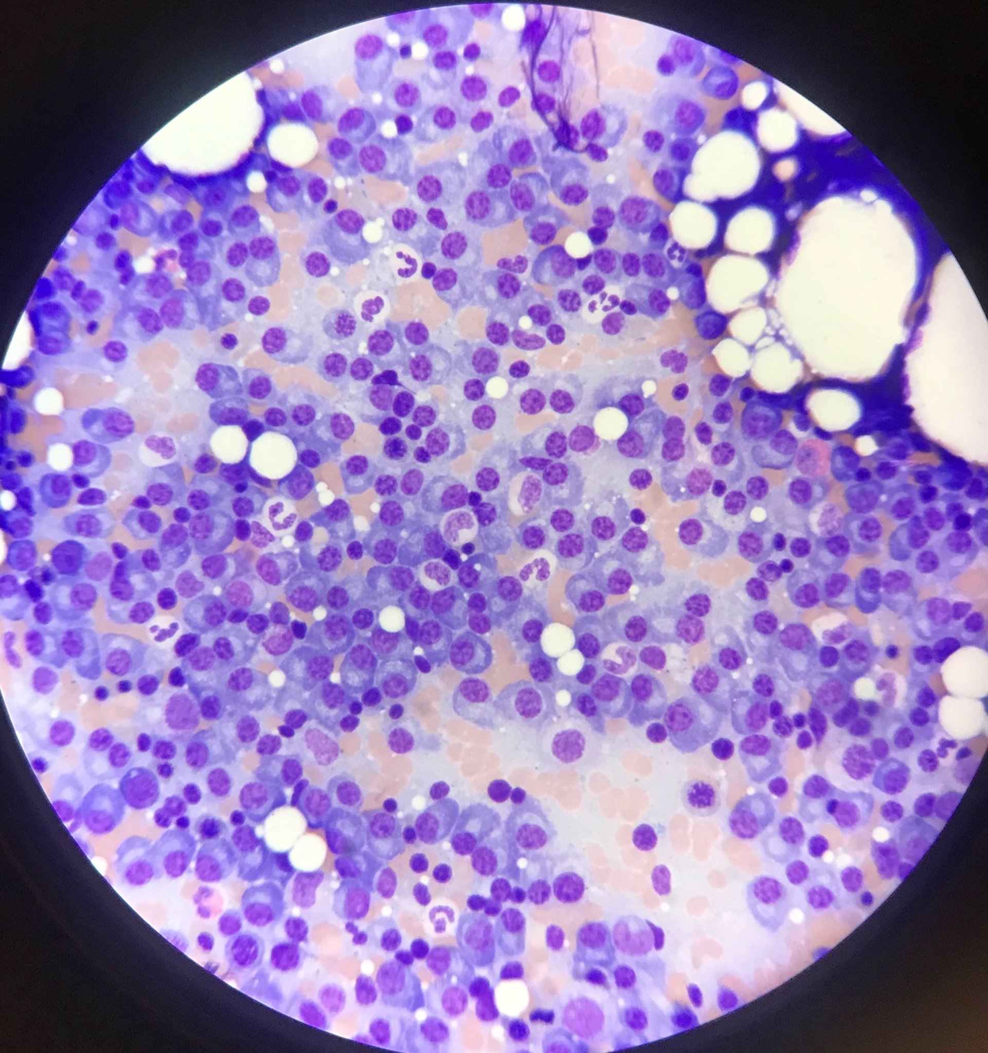 Investigadores españoles demuestran en ratones la efectividad de un nuevo tipo de inmunoterapia contra mieloma múltiple
