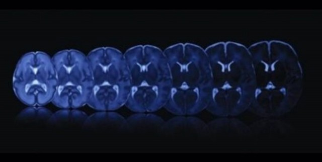 Un estudio internacional analizará la formación del cerebro durante la gestación
