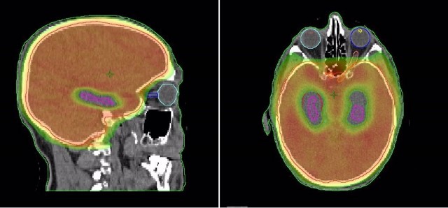 Un estudio cambia el abordaje del tratamiento de la metástasis cerebral en cáncer de pulmón
