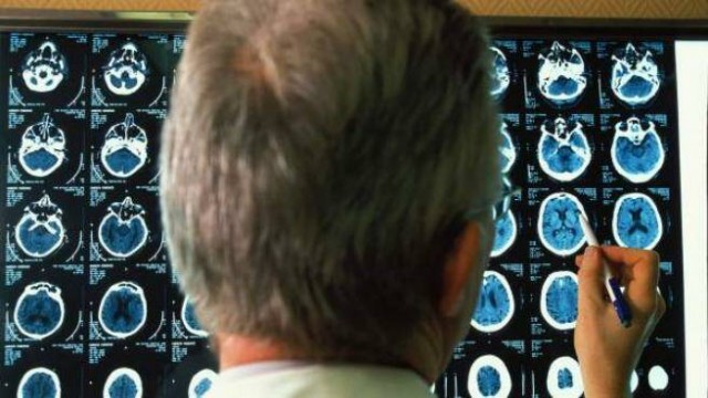 Identifican la causa probable del Alzheimer: la fuga de protenínas tóxicas de la sangre al cerebro