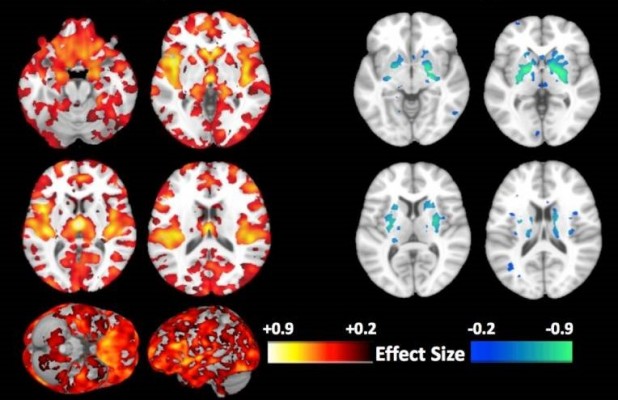 Desarrollan un método novedoso para predecir el riesgo de esquizofrenia en etapas tempranas de la vida
