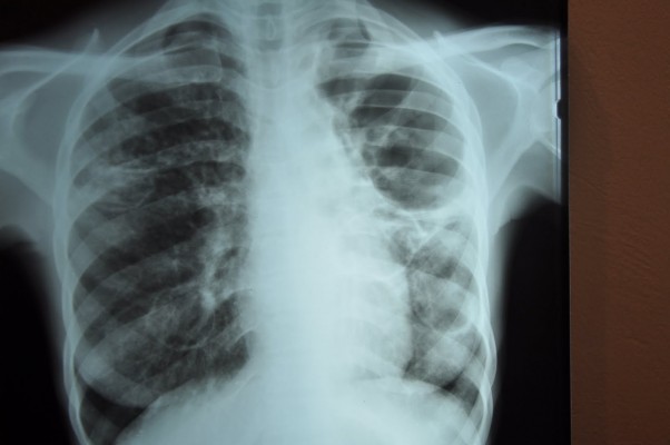 La tuberculosis mata a 5.000 personas cada día 