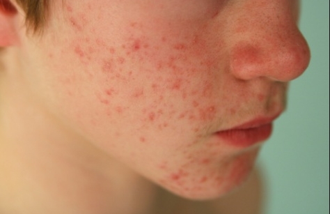 Uno de cada cinco niños tiene piel con tendencia atópica