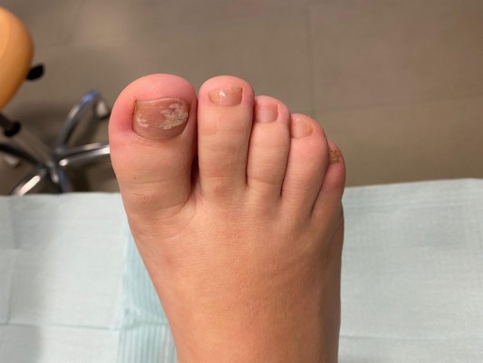 Los podólogos advierten de que los esmaltes permanentes pueden causar hongos en las uñas de los pies