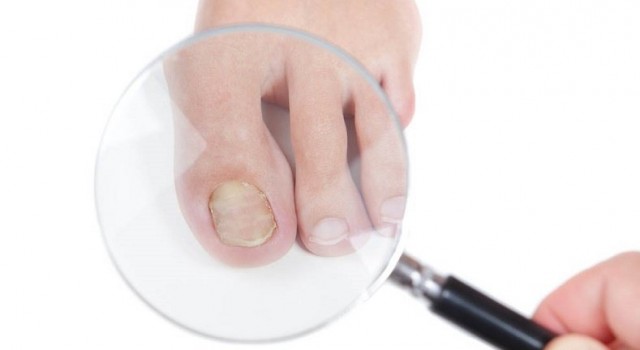Un 15% de la población mundial que vive en zonas industrializadas tiene hongos en las uñas de los pies

