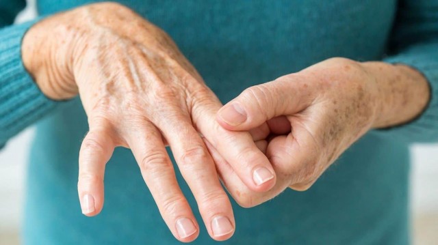 La artritis reumatoide