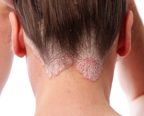 La psoriasis