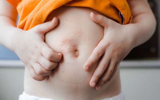 El 80% de hijos de padres con dermatitis atópica desarrollará la enfermedad