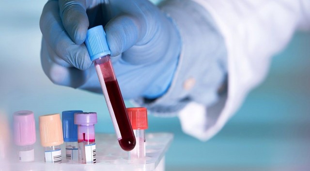 Un análisis de sangre podría reemplazar la cirugía para algunos pacientes con tumores cerebrales
