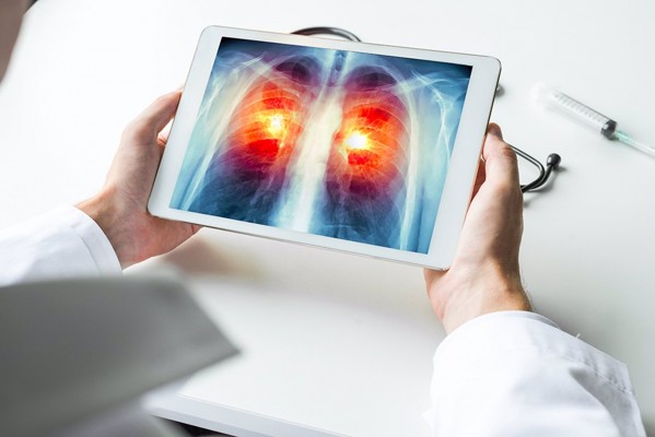 Expertos alertan de una subida del 6,5% de las muertes por cáncer de pulmón en mujeres