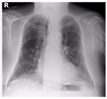 Científicos valencianos y americanos organizan un reto para detectar covid en radiografías de tórax