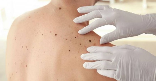 Expertos destacan la importancia de la prevención para evitar

y detectar a tiempo el cáncer de piel
